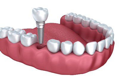 single-teeth-implant